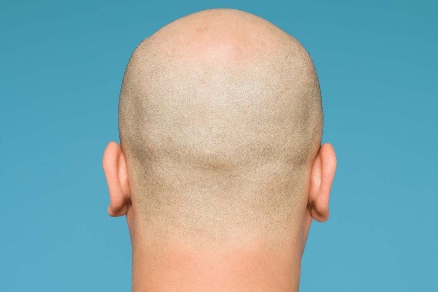 The study shows that bald men are at a higher risk of developing severe COVID