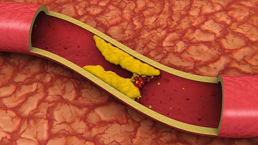 High cholesterol in children: is there anything to worry about?