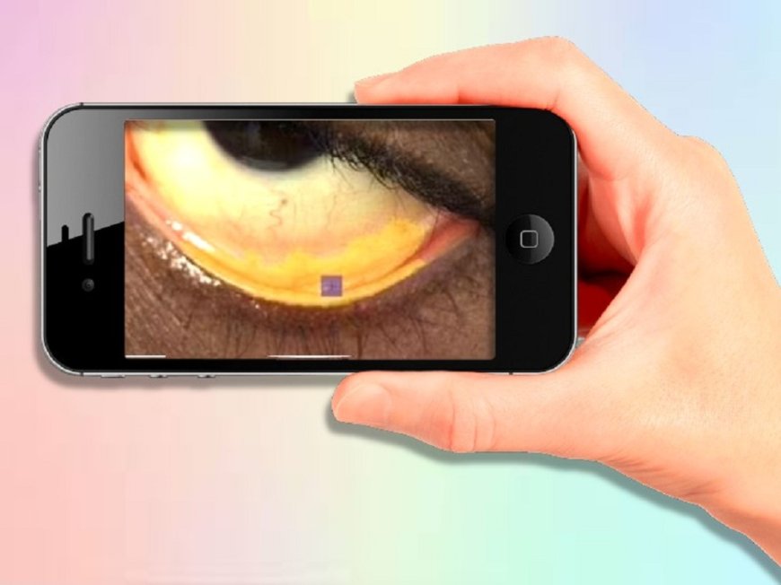 Smartphones can already detect anemia! Just take a picture
