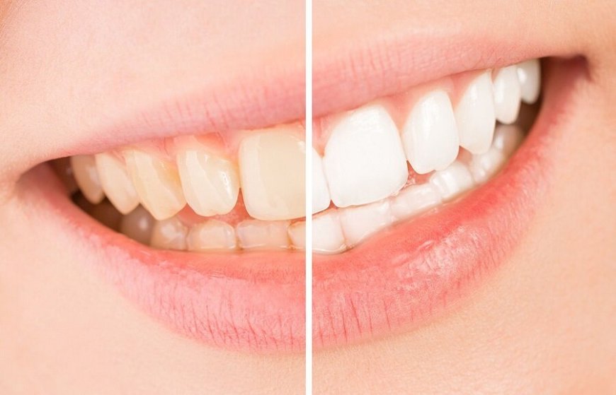 The causes of discolored teeth